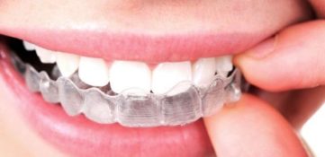 Елайнери Invisalign